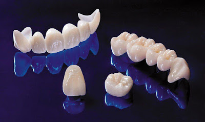 Thế nào là trồng răng sứ nguyên hàm? 