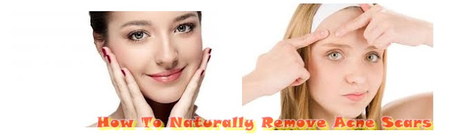 How To Naturally Remove Acne Scars