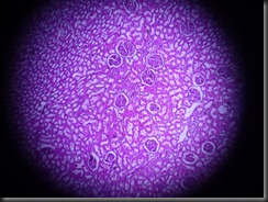 renal cell CA high resolution histology slide tsnaps