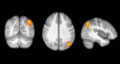 Exames de ressonância magnética funcional de portadores de tontura refratária ao tratamento sugerem atividade exacerbada nas vias cerebrais relacionadas com ansiedade e medo 