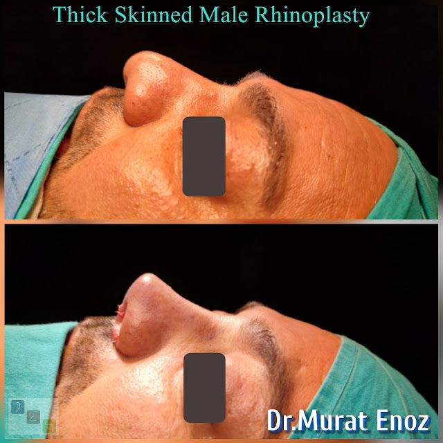 Male Nose Job,Thick Skinned Male Rhinoplasty,Rhinoplasty in Men Istanbul,