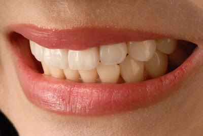 usuwanie zębów stałych w gabinecie stomatologicznym Dentysta Bydgoszcz