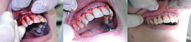 <Img src ="Cirugía-colgajo-periodontal-con-osteointegrador.jpg" width = "893" height "201" border = "0" alt = "Cirugía periodontal mediante colgajo periodontal.">