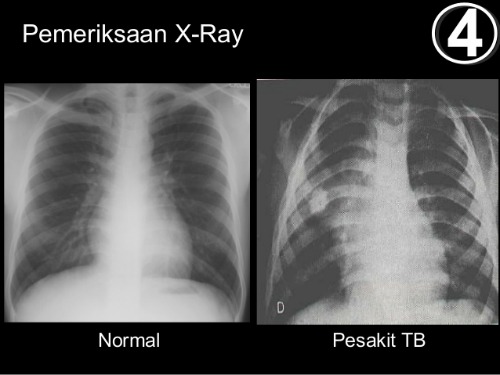 Vitamin Yati: Vitamin Shaklee Untuk Pesakit Tibi Kembali 