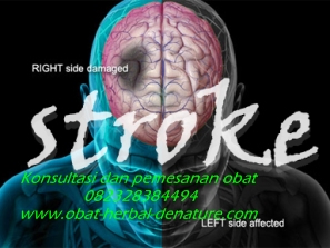 obat stroke herbal,obat herbal stroke,obat stroke denature,obat lumpuh separo,obat stroke ringan,obat stroke berat