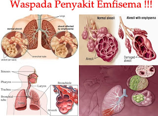 penyakit emfisema