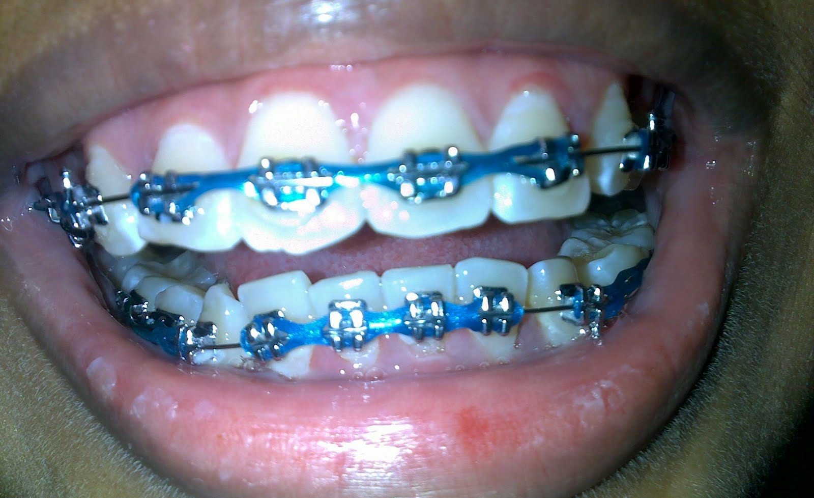 Some stories to share: Colour for your braces