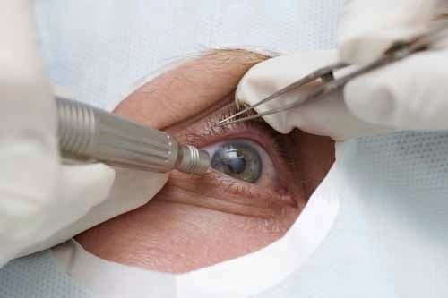 Kalsiyum riskini artıran lazer göz ameliyatı
