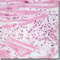 THYPUS ABDOMINALIS