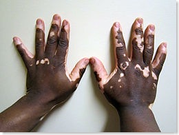 Vitiligo2