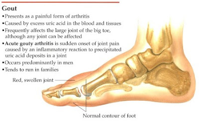 gout home remedies