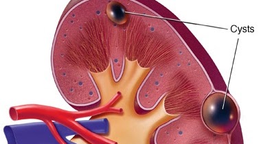 Rawatan Herba Dan Pemakanan: Rawatan Kidney Cyst (Cyst 