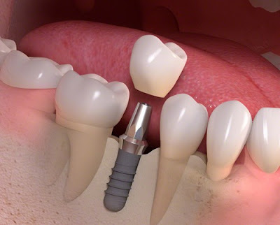 Nên cầu răng sứ hay làm Implant nha khoa?