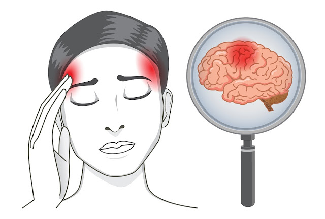 Pengobatan sakit stroke dengan Konsep Karnus