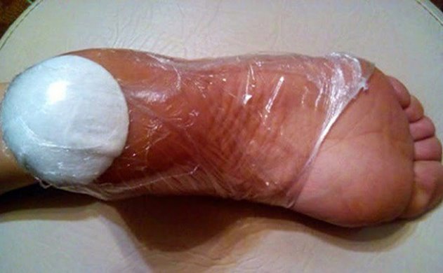 Trik Sederhana Untuk Mengatasi Telapak Kaki Pecah Pecah