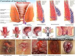 Tips Manjur Untuk Pengobatan Ambeien