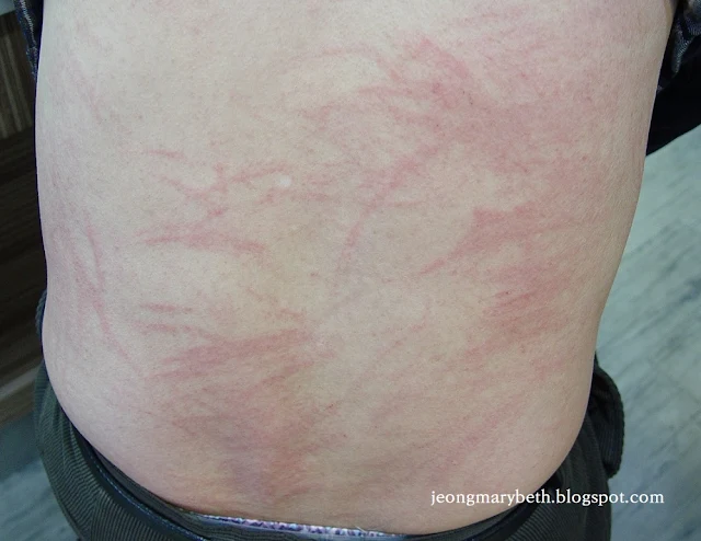 표고버섯피부염(Shiitake Dermatitis) 이미지