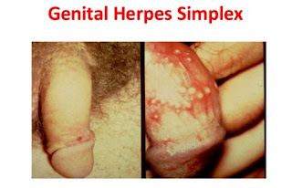 Berapa Harga Obat Herpes Gangjie Ghosiah Di Surakarta