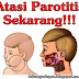 Obat Parotitis (Mumps Atau Gondongan) Pada Dewasa