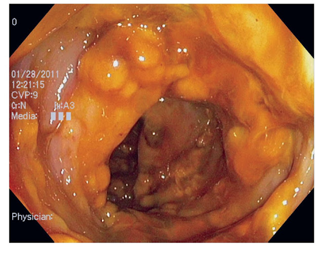 Este epitelio intestinal debería ser plano y rosado