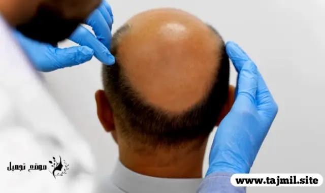 أسعار عمليات زراعة الشعر في تركيا - إسطنبول: تكاليف وتفاصيل العلاج