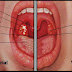 Swollen Tonsils, Swollen Throat or Sore Tonsils - Causes, Symptoms, Treatment, Home Remedies and Prevention -