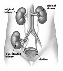  India Kidney Transplant | Cost Kidney Transplant India