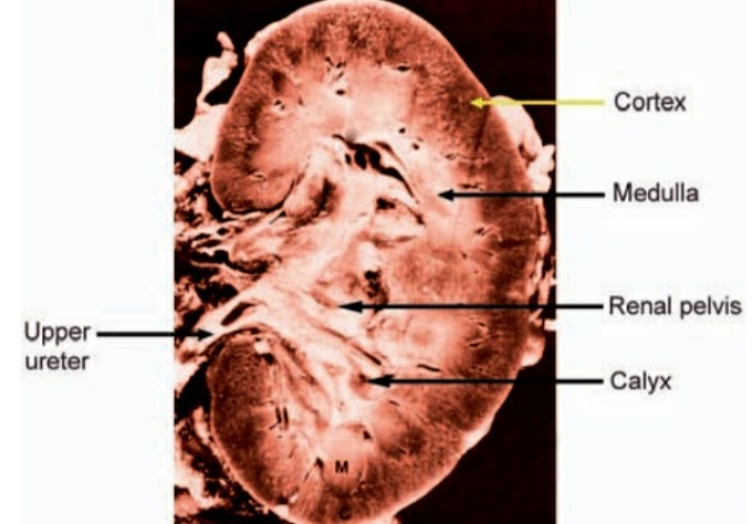 Homoeopathic Treatment of Renal Stone