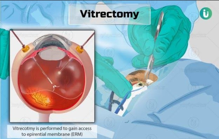 How is a vitrectomy performed?