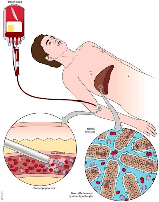 Transfusion Associated Circulatory Overload. Blood transfusion is the