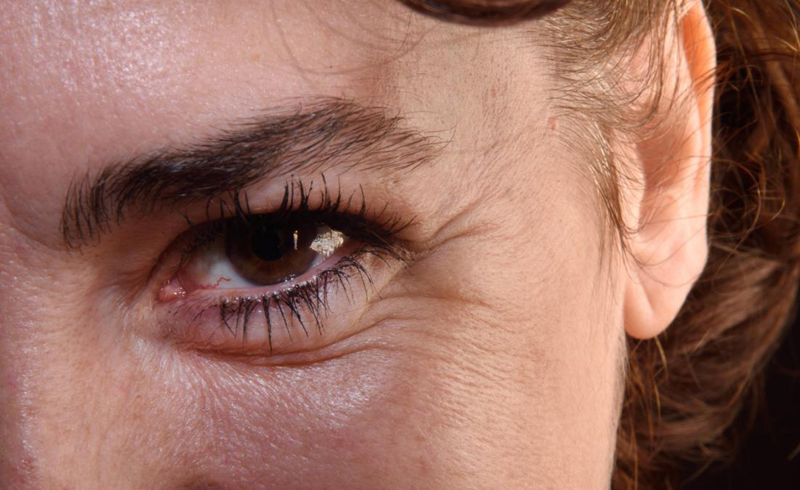 How to Manage Under-Eye Wrinkles 