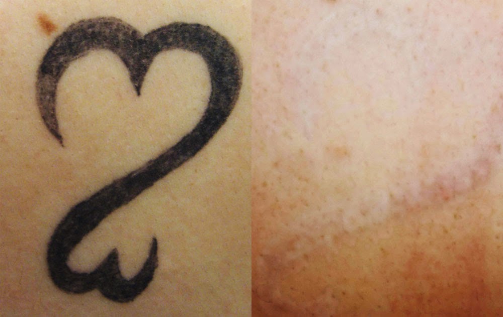 Tattoo Removal