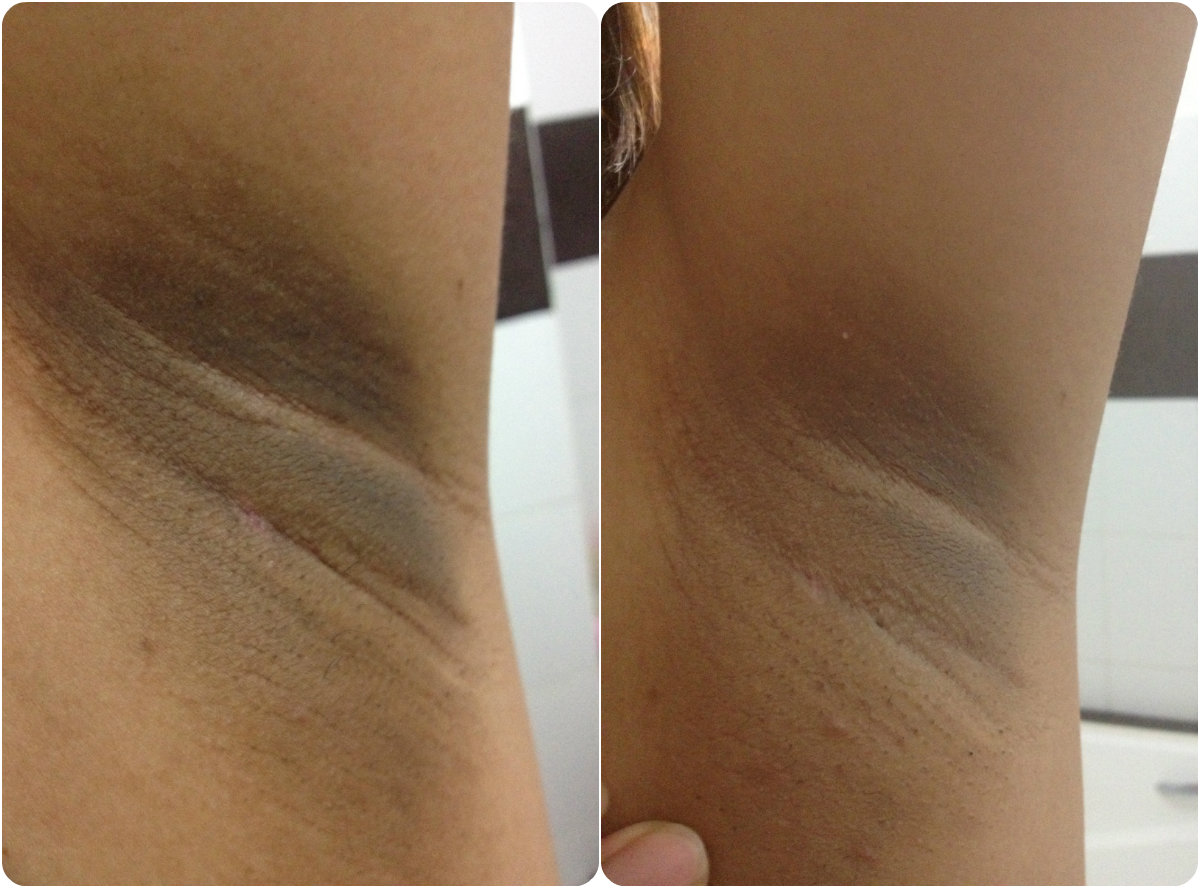 Underarm Whitening F   or Dark Underarms Skin Lightening Pro 