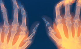 Artrit hastalığı için ameliyatsız kesin tedavi