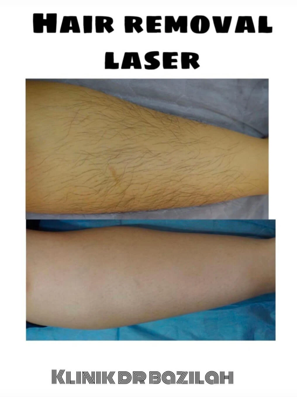 Rawatan 'Hair Removal Laser' Klinik Dr Bazilah Atasi Masalah Bulu Berlebihan Wanita. Selamat dan Tidak Menyakitkan