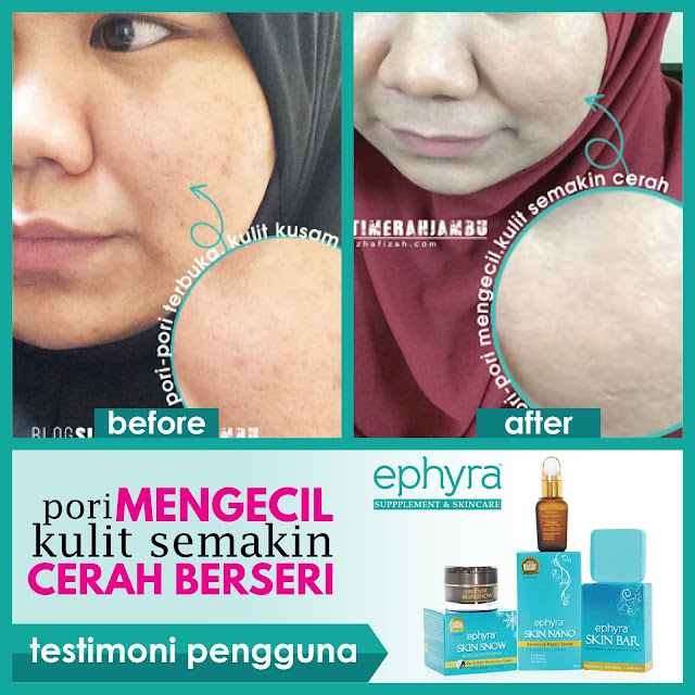 Testimoni Ephyra Skin Snow