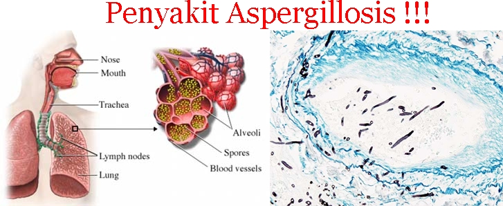 Obat Tradisional Aspergillosis