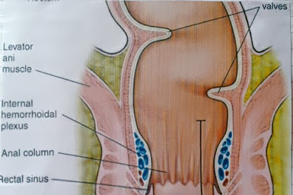 Hemorrhoids Symptoms, Signs, Causes And Hemorrhoids Treatment