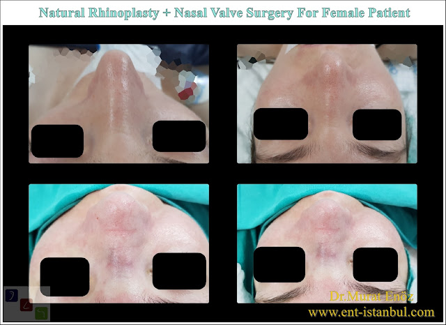 Natural rhinoplasty in Istanbul,nose job for female patient,Nasal valve collapse surgery,droopy nose tip aesthetic,