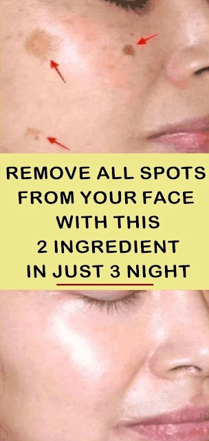 AMAZING: This 2-Ingredient Remedy Removes All Spots From Your Face in Just 3 Nights!