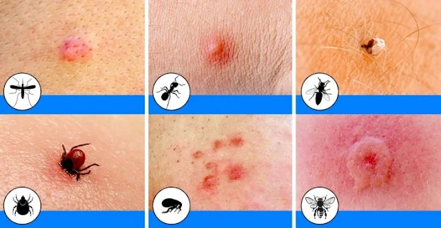 12 Common Insect Bites And How To Recognize Each One