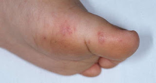 Rashes on a patient's foot, which is one of the symptoms of hand foot and mouth disease pictures