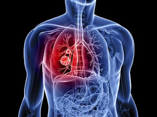 Gejala dan Pencegahan Kanker Paru-paru