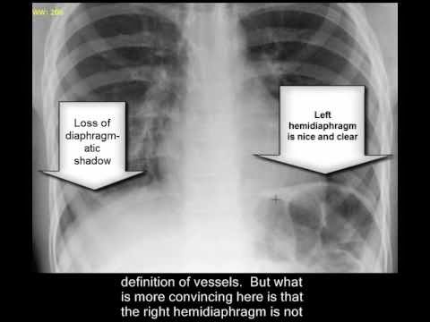 http://pathologyvideos.blogspot.ro/2014/04/chest-x-ray-pneumonia.html