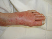 Doctors Gates: Cellulitis PIC