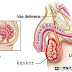 Kanker Testis