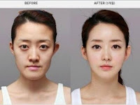 Mau Operasi Plastik?  15 Foto Operasi Plastik Orang Korea yang Bikin Kamu Geleng-geleng Kepala