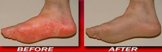 Athletes Foot before and after