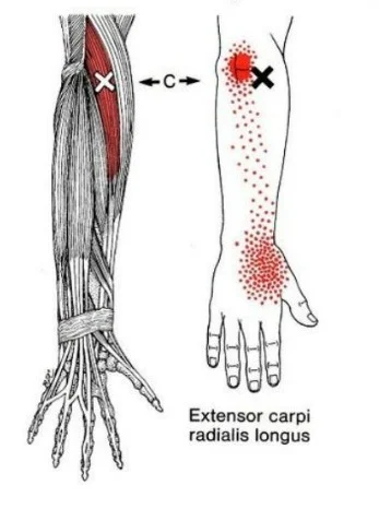 Antebrazo y muñeca - extensor cubital largo del carpo - MCdevservices Spa