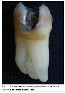 MANDIBULAR FIRST MOLAR